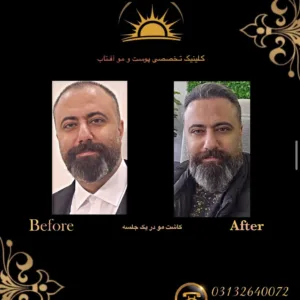 کاشت مو و ابرو کلینیک آفتاب