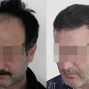 کاشت مو و ابرو در اصفهان کلینیک آفتاب
